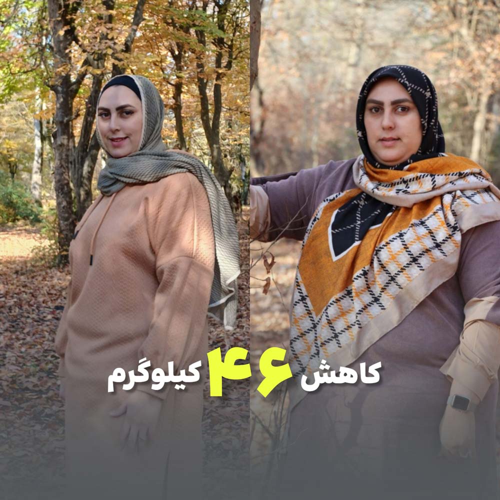46 کیلو کاهش وزن. 11 ماه بعد از مینی بای پس